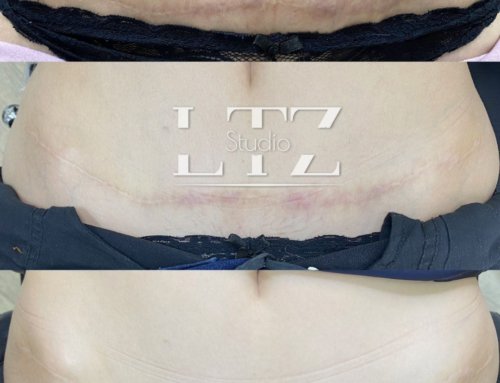 Tratamento de Cicatrizes – Tayna Leutz