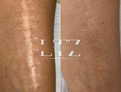 Tratamento de Cicatrizes – Tayna Leutz